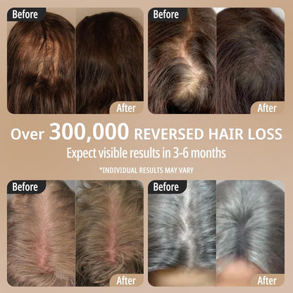 Scalp 3L Laser Hair Growth Comb with 650Nm Infrared Technology, 360° Scalp Massager, Waterproof Design, Effective Scalp Stimulation and Hair Regrowth